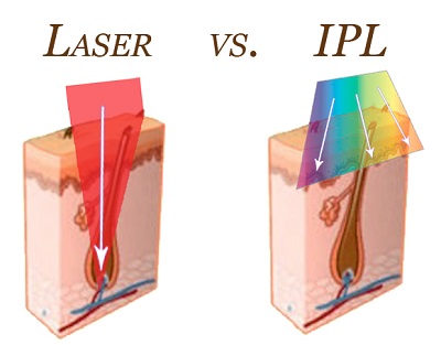 ipl lazer nedir4